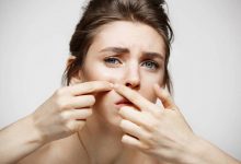 痘痘留痕超困扰 医揭「3痘疤」如何生成-资源分享网