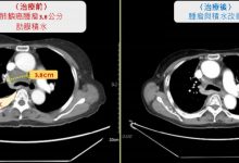 7旬嬷肺鳞癌第4期 积极治疗肿瘤缩到几乎不见-资源分享网