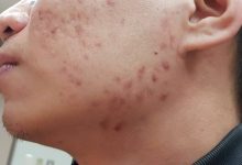 27岁男满脸青春痘想交女友 经治疗重获自信追爱情-资源分享网