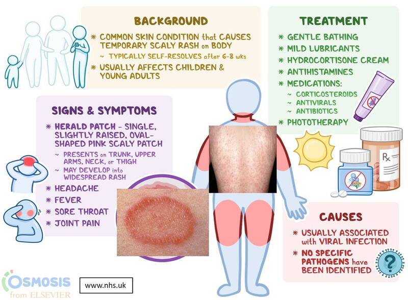 医师表示,玫瑰糠疹目前致病原因仍不明,还有待更进一步的研究釐清。(图片取自脸书专页「皮肤科日常菡养 高珮菡医师」)
