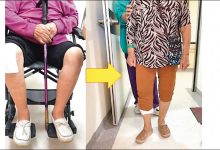 髂静脉支架手术 下肢水肿长者新选择-资源分享网