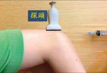 手肘后侧红肿痛 鹰嘴突滑囊炎上身-资源分享网