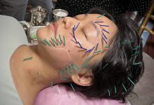 扎美颜针看起来好痛! 中医:针具比髮丝细、痛感轻微-资源分享网