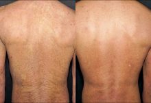 异位性皮肤炎反覆 需注重保湿-资源分享网