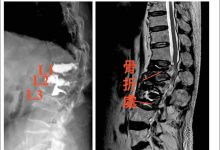 老翁7个月3次骨折 骨质疏鬆惹祸-资源分享网