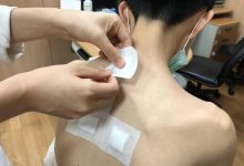 除三伏贴印子！ 医：维生素CE、中药调理可淡化-资源分享网