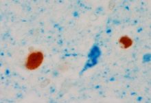 顶尖期刊阿兹海默症论文传「造假」 学者分析：不影响现有治疗-资源分享网